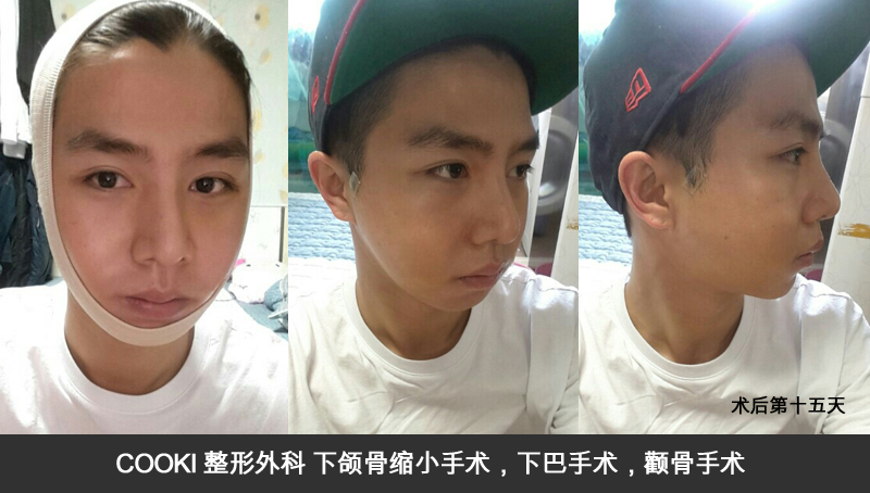 下颌骨缩小手术,下巴手术,颧骨手术手术第十五天