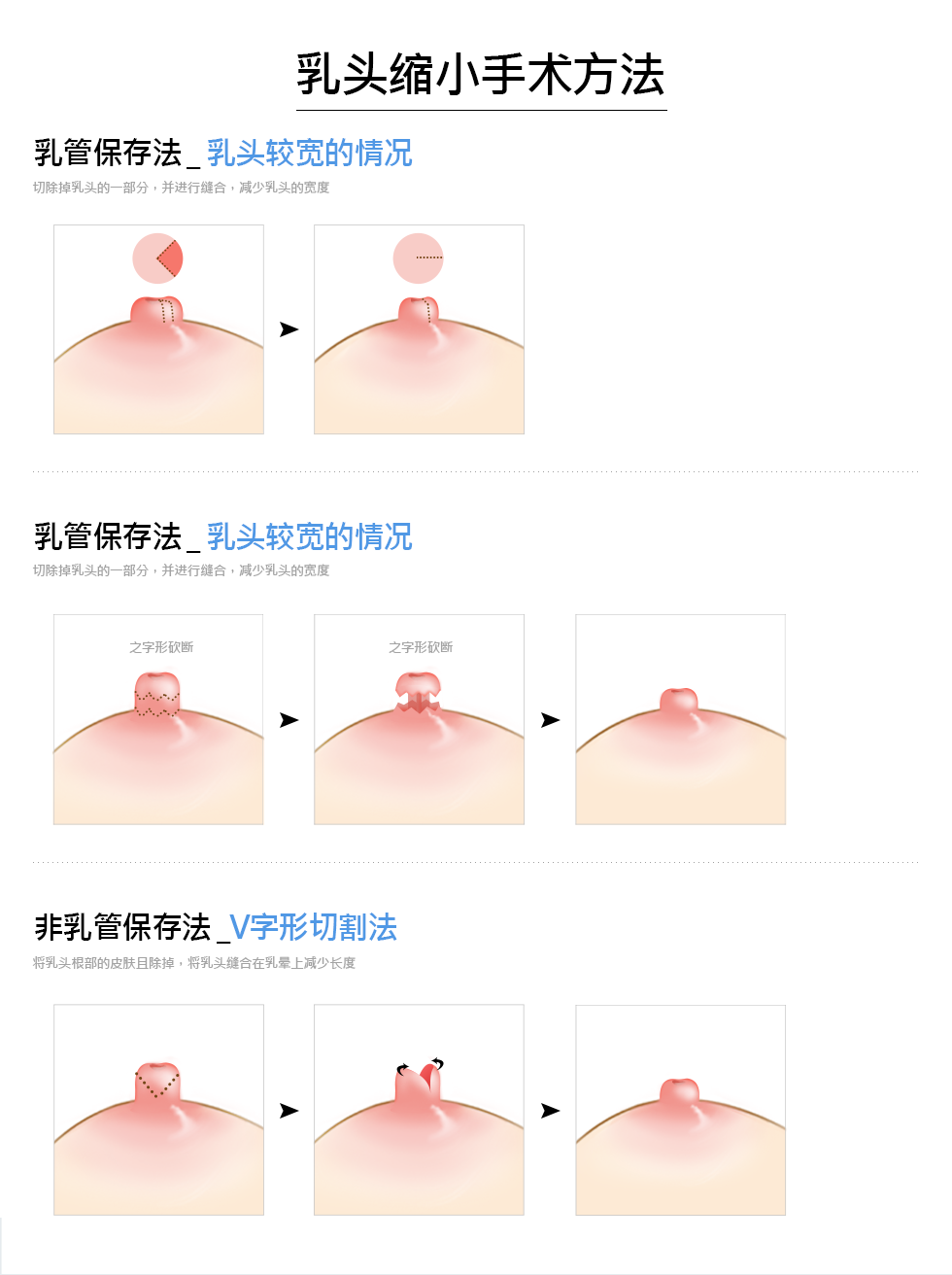 73+ 图片 乳头 新的 7 胸部/体型整形- 乳头缩小术